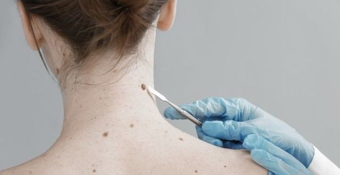 El cáncer de piel es el enemigo invisible que sí puedes evitar